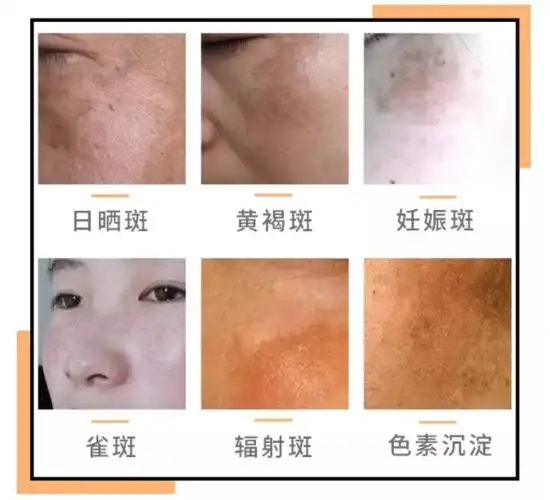女性脸上常见的斑点有哪些?
