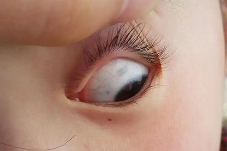 孩子眼白有"黑点"?医生:别慌,大多是这三种原因在作祟