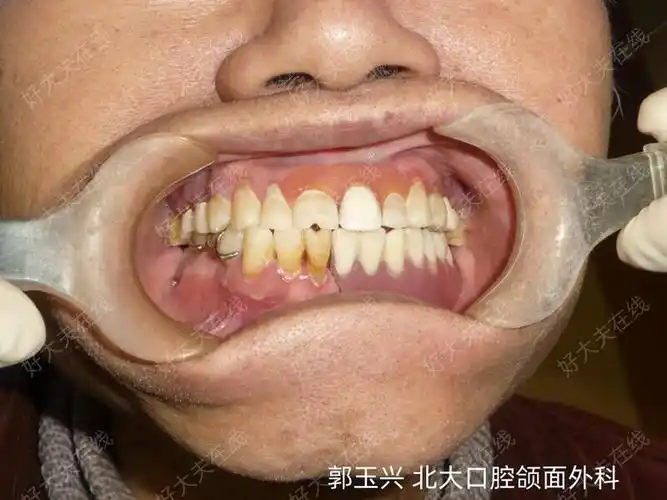 颌骨刮治术_颌骨骨髓炎 - 好大夫在线