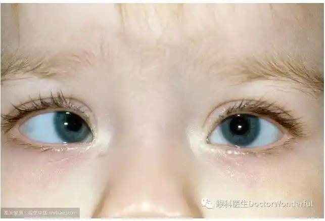 发生在单眼,患儿有斜视或曾有过斜视,常见于四岁以下发病的单眼恒定性