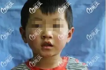 轻微隐形唇裂不做手术将来会后悔那么单侧轻度唇裂得做几次手术才会好
