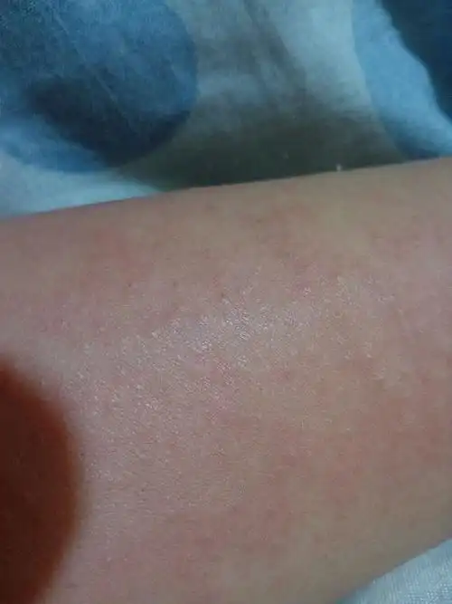 手臂上长这种小红点 很痒 是不是过敏了啊