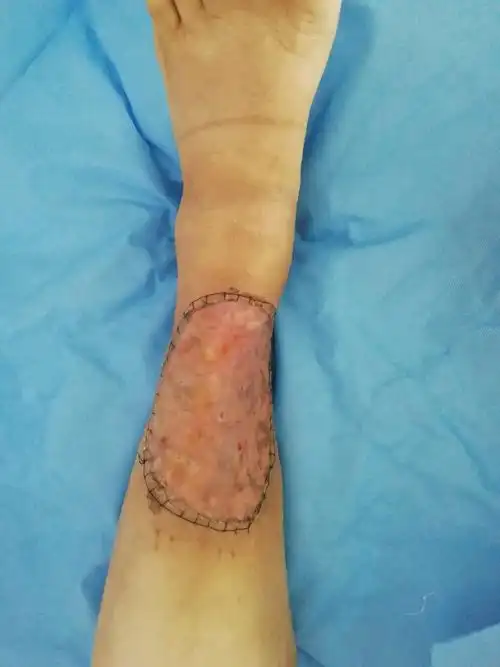 术后一周小腿植皮照片
