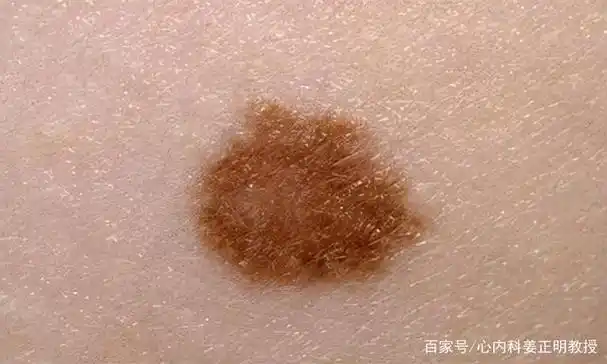 几个月前,她发现脸上忽然长出了几个褐色的斑点,她以为是太阳晒多了