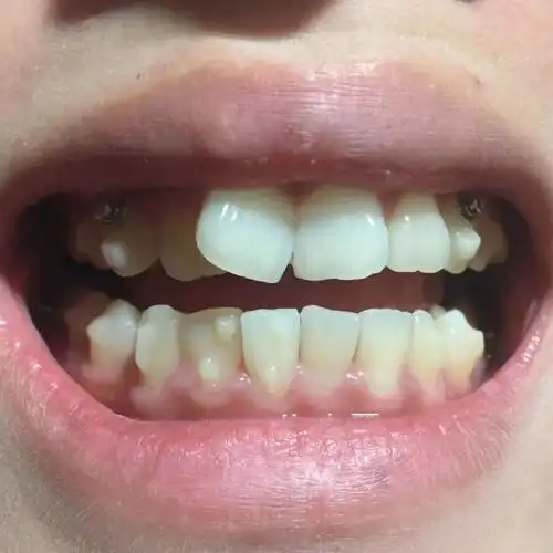 牙牙聊正畸 的想法: 牙齿矫正——这样的门牙不做正畸会遗憾终