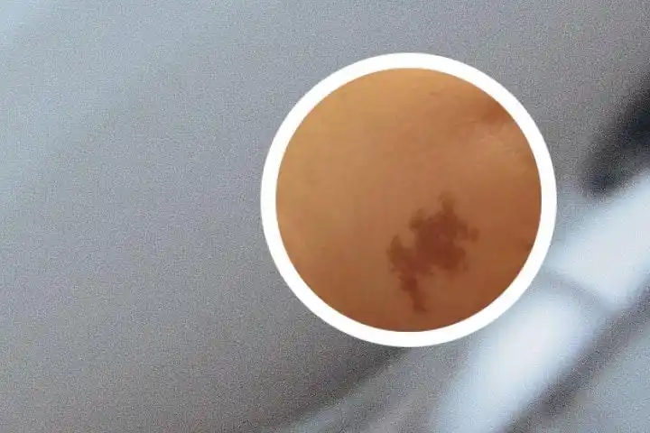 身上长了好多咖啡斑图片男