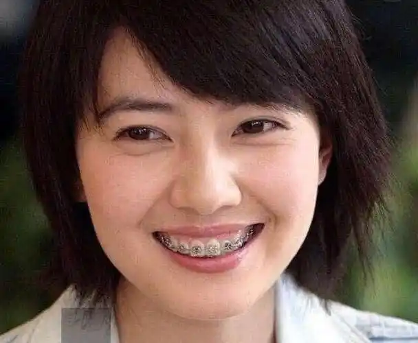 整牙如整容龅牙男网红晒整牙过程图3年后卸下牙套秒变许光汉