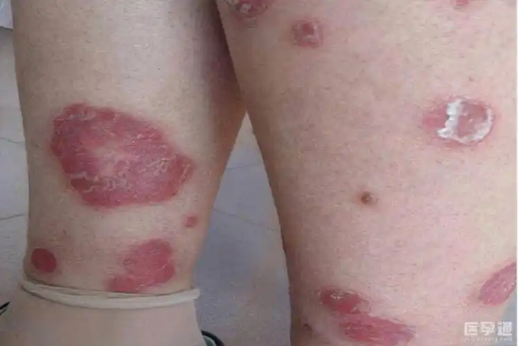 皮肤癌早期症状图片解析,出现这些症状千万别大意