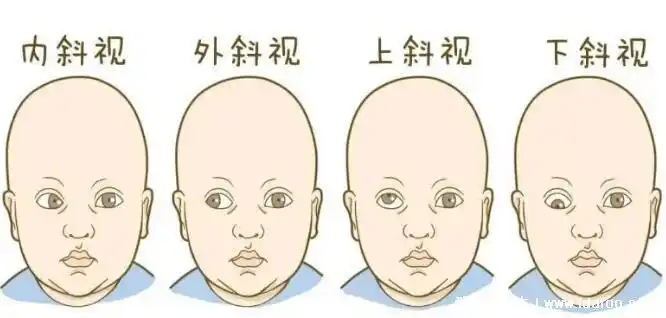 婴儿的斗鸡眼是以下原因导致