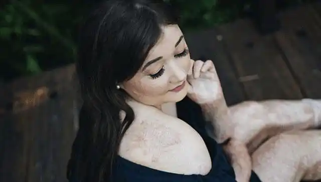 英国女孩全身60%烧伤