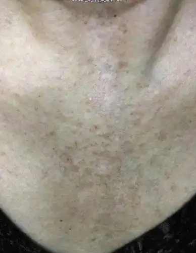 研究快讯前额纤维化脱发的毛发外损害