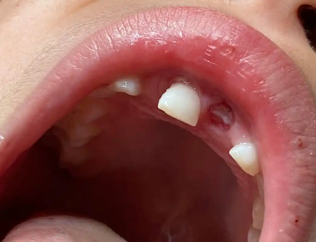 额～乳牙门牙掉一半?07.