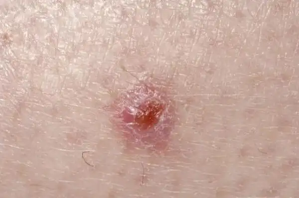 皮肤癌的症状变化及其特点