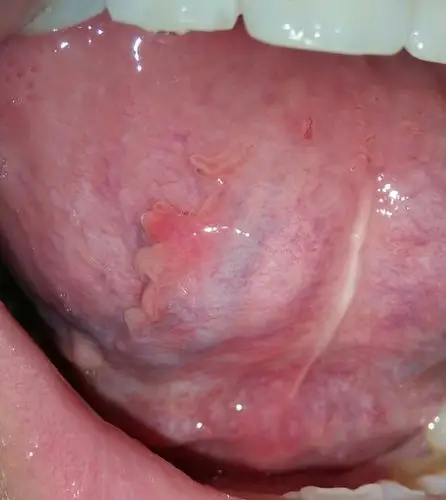 前段时间口腔溃疡刚好,这段时间又长了这个,到 舌头下面肿了,不知道是