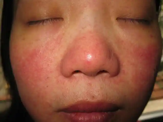 皮炎平至面部激素依赖性皮炎