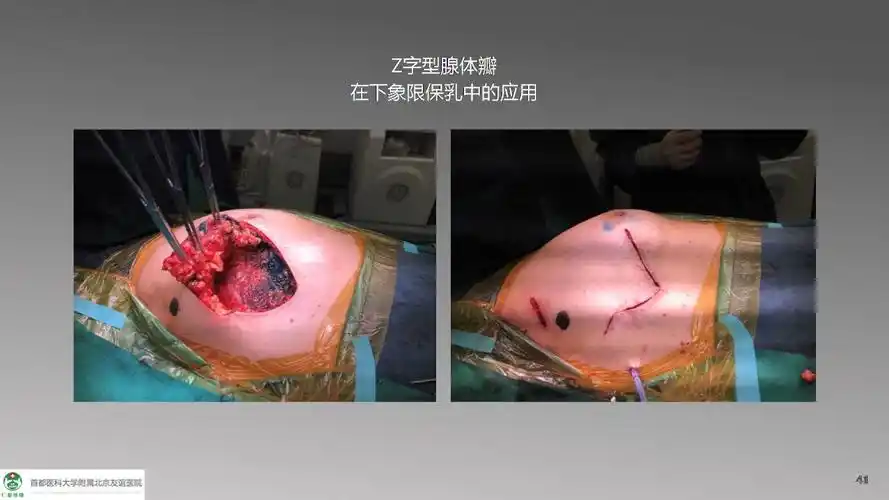 乳腺癌手术切口设计与技巧