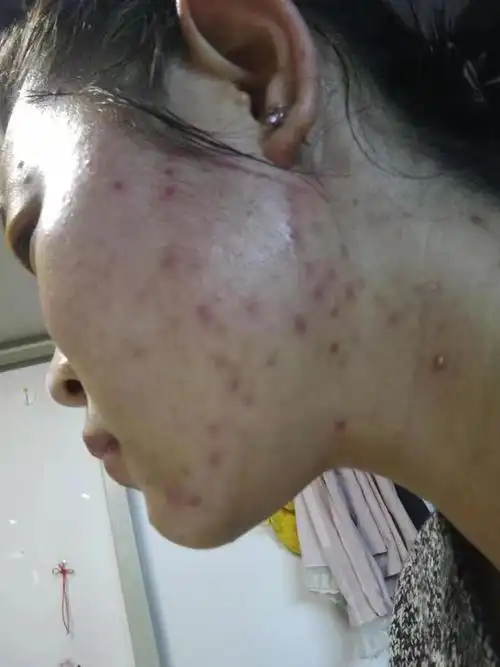 花斑癣多久才能治好