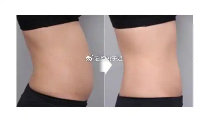 因为吸脂的部位是腰腹就想问下经常坐着会不会对恢复有什么影响呢?