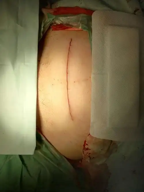 不要换药,术后15天所有刀口上东西摘掉,酒精擦干净,拍照片给我看看,发