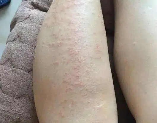 肿瘤医生:不论男女,皮肤一旦有这"标志",癌症已"近在咫尺"