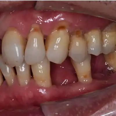 牙齿美容修复可以改善哪些问题?注意事项有什么?