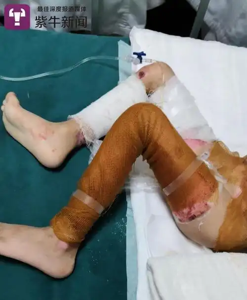 煤气爆炸4岁娃双手截肢爸爸遇难妈妈离开医院失联
