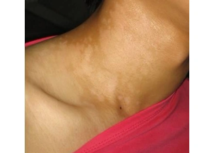 汗斑图片大全51