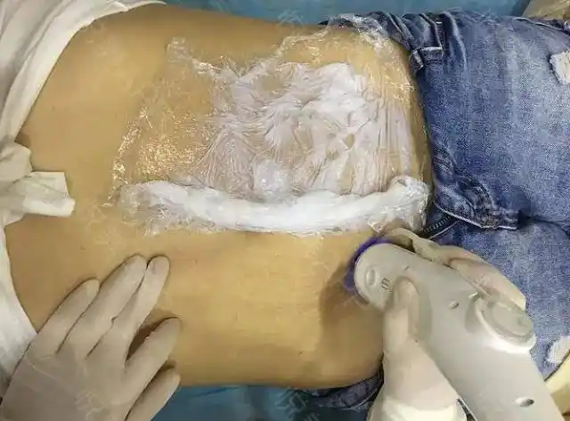 女性肚子上的妊娠纹应该怎么去除