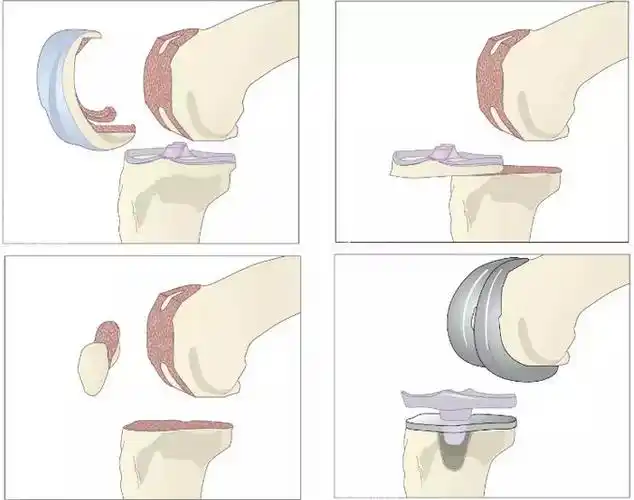 膝关节置换术示意图及部分手术风险解读