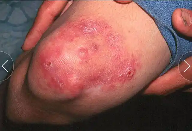 鉴别细菌性皮肤病 挑战你的诊断力