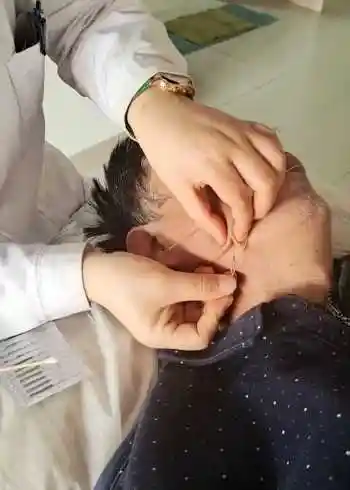 针灸治疗面瘫,口脸歪些吐字不清