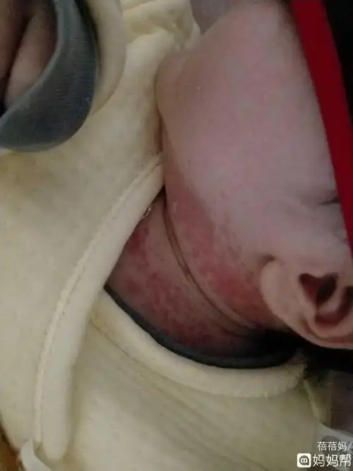 宝宝出生12天脖子湿疹很严重怎么办