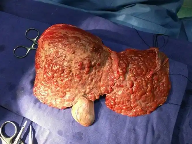 酒精肝的损伤症状的图片