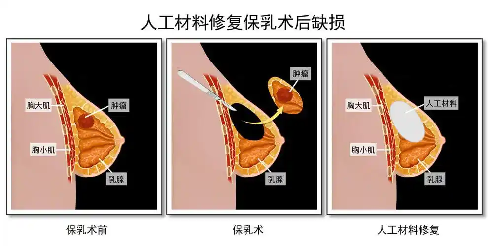 乳房整形与重建手术包括乳头整形与重建,巨乳缩小,垂乳上提,乳房假体