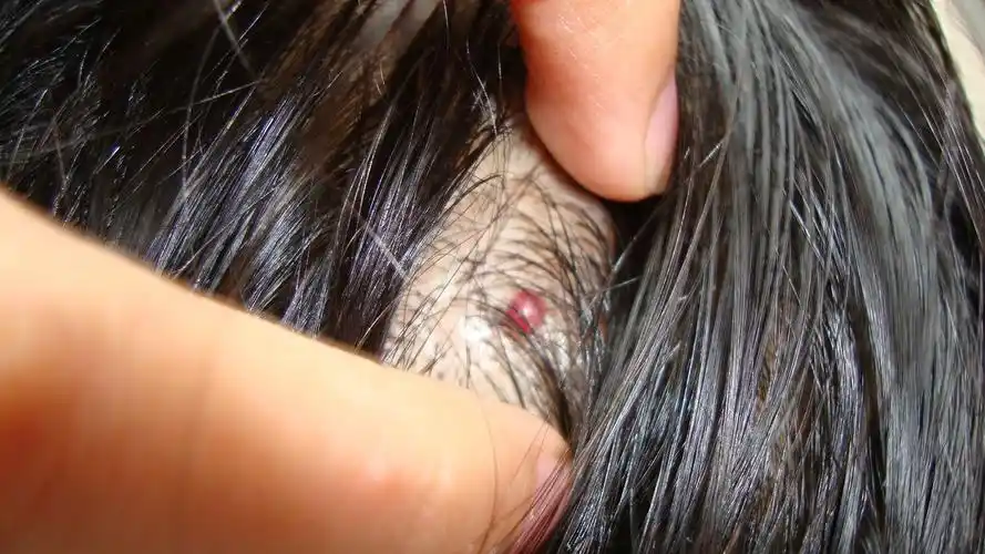 患者信息:女20岁山东淄博病情描述(发病时间,主要症状等):我头顶有个