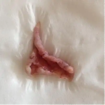 怀孕47天流血并流出一块肉一样的东西(如图药水泡过的)至今还有点点