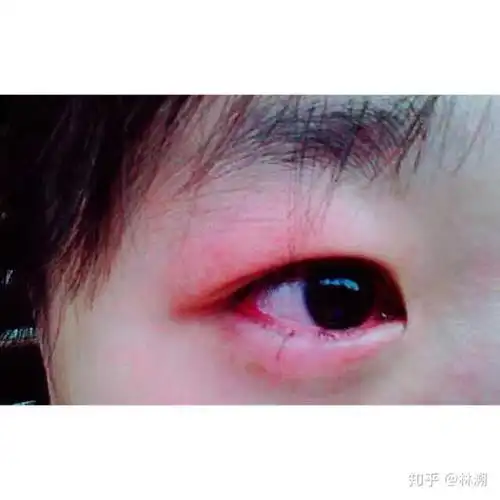 忘了是因为什么哭的 反正当时眼睛真的特别疼