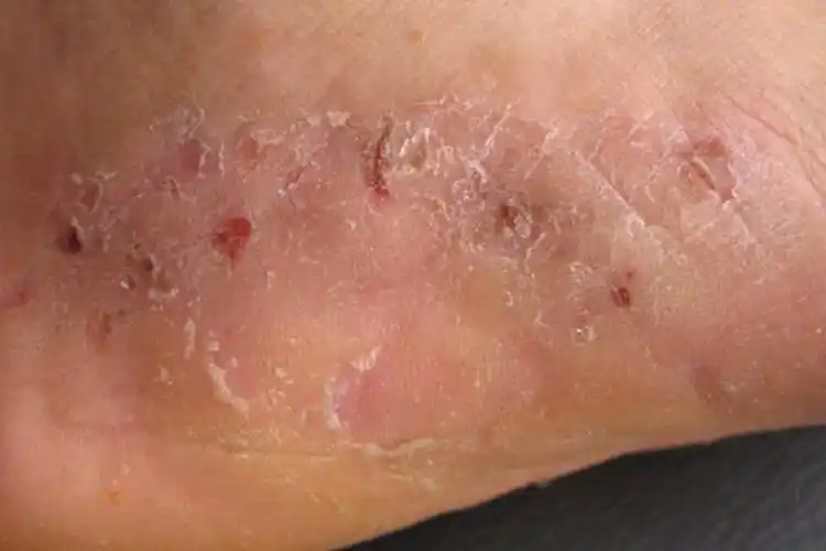 手上感染了脚气图片