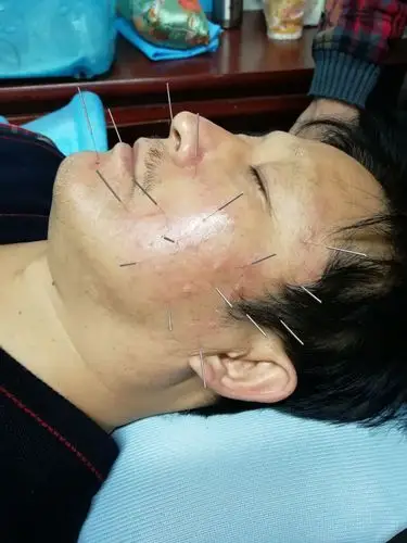 针灸治疗面瘫
