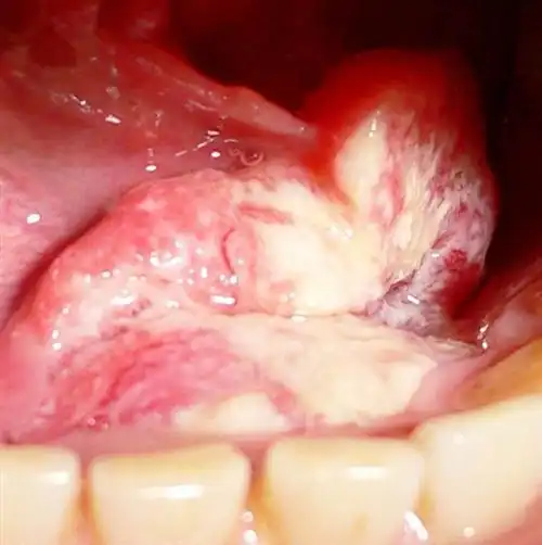 下颌骨癌的前症状