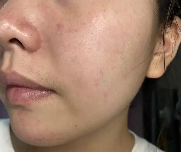 求助小仙女们,我脸上这些是红血丝还是肌肤屏障受损啊