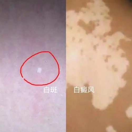 恼人的白斑,苏州五院皮肤科名医工作室教你来鉴别_色素