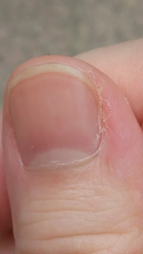 右手大拇指右边长出来这样也一块不知道是皮还是指甲的,很硬的一块