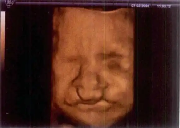 生了唇腭裂宝宝怎么办 —— 什么是唇裂?