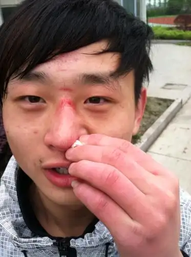 我和同学玩,把他鼻子撞出血了,撞在地上的,现在还在流血,有事吗,要不