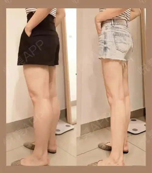 体验项目:吸脂瘦腿