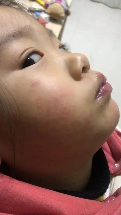 1条回答  湿疹 表现:开始是红色的小丘疹,有渗液,最后可结痂,脱屑,反