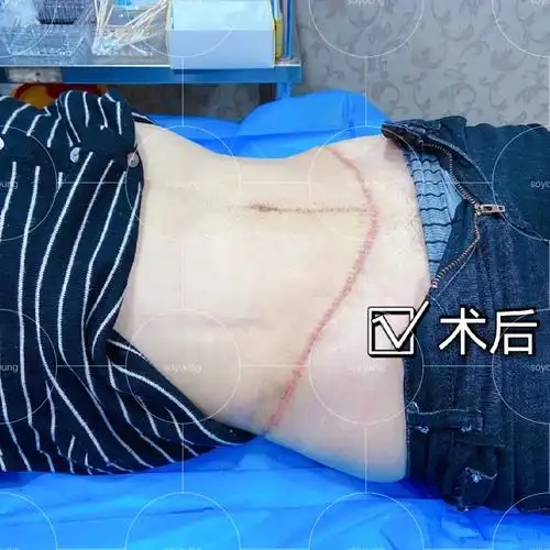 腹壁整形术,两周拆线反馈!