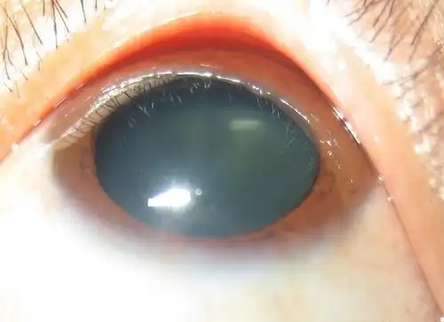 死者眼睛真能残留死前人影吗法医尸检时为什么要看死者双眼