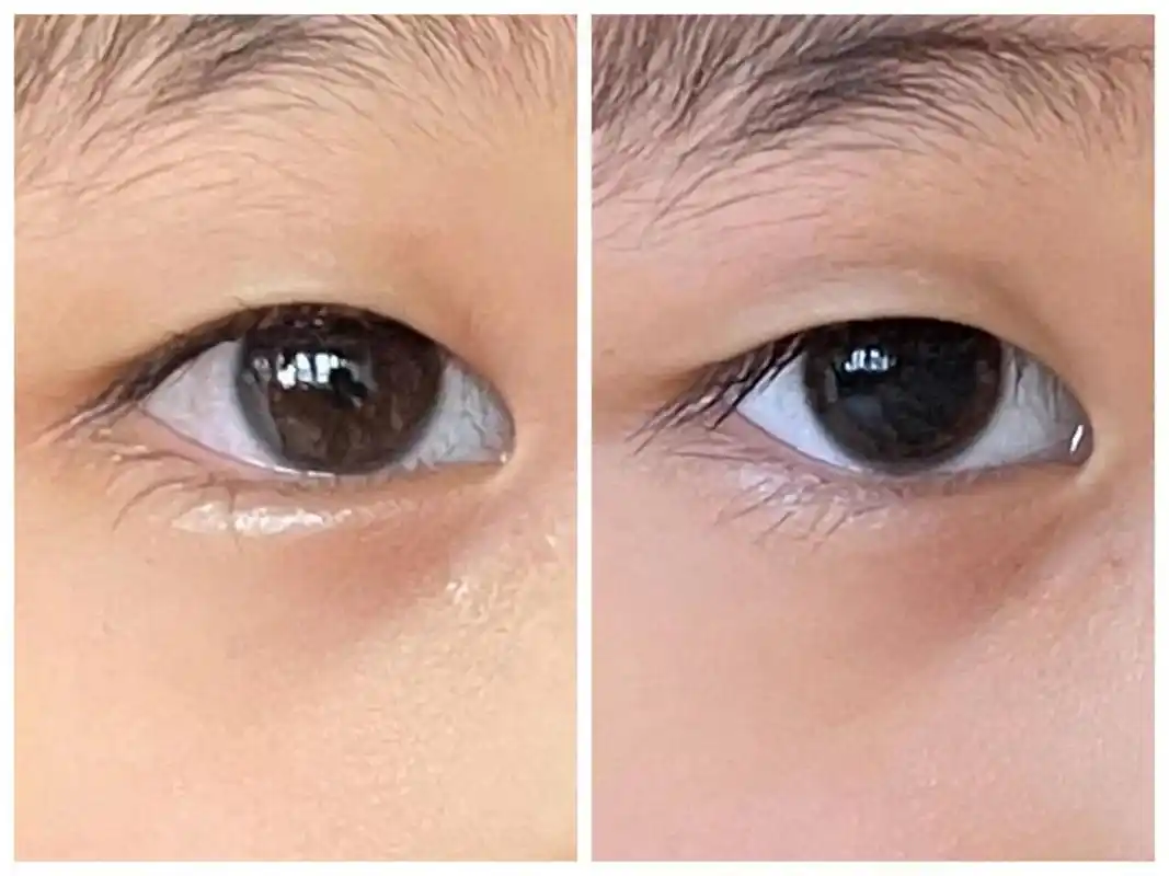 散瞳日记 滴药水第一天 小朋友反馈药水进眼的时候有些酸酸的疼 会不